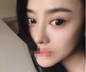 親身經(jīng)驗(yàn)，重慶星范整形的超體隆鼻真的很自然