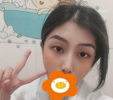 溫州韓美周杰群醫(yī)生耳軟骨隆鼻案例分享術(shù)后三個月效果 溫州韓美周杰群醫(yī)生耳軟骨隆鼻案例分享術(shù)后三個月效果