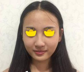塌鼻子小妹在深圳鵬愛做隆鼻手術，三個月后竟然是這樣的