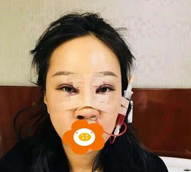 鄭州禾麗做肋軟骨隆鼻術(shù)后兩天效果 鄭州禾麗做肋軟骨隆鼻術(shù)后兩天效果