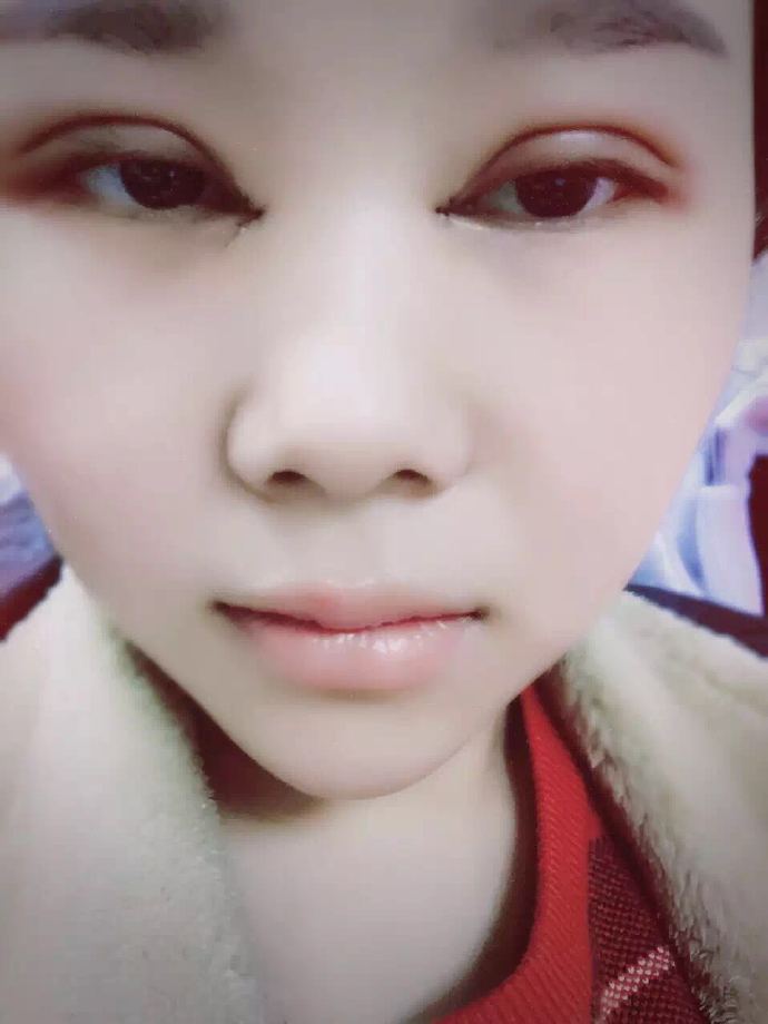 汕頭曙光雙眼皮手術(shù)當(dāng)天