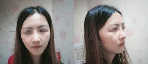 濱州醫(yī)學(xué)院附屬醫(yī)院做隆鼻一個月效果 濱州醫(yī)學(xué)院附屬醫(yī)院做隆鼻一個月效果