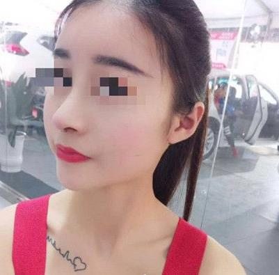 石家莊諾萬(wàn)整形姚華榮硅膠隆鼻效果分享，同款酒糟鼻值得一試