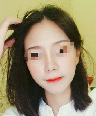 首都醫(yī)科大學(xué)附屬北京友誼醫(yī)院醫(yī)學(xué)美容中心耳軟骨隆鼻案例術(shù)后一個月效果