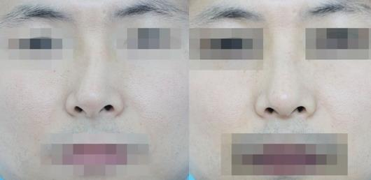 不要被營銷號帶偏了，鼻骨矯正其實很簡單