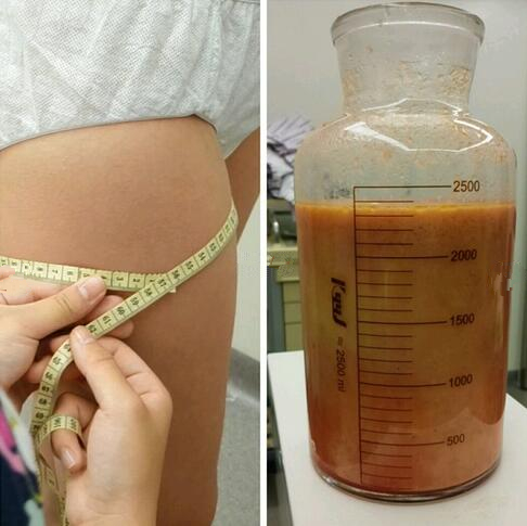 成都趙博士整形大腿吸脂案例吸脂量