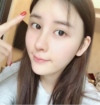 蘭州美月做膨體隆鼻術(shù)后兩個(gè)月效果 蘭州美月做膨體隆鼻術(shù)后兩個(gè)月效果