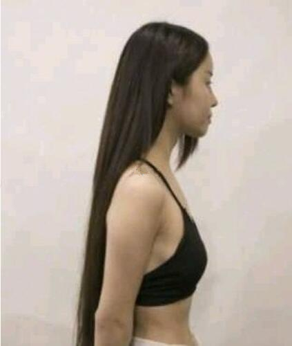 濟南海峽整形假體隆胸術(shù)前效果 濟南海峽整形假體隆胸術(shù)前效果