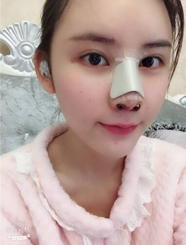 蘭州美月做膨體隆鼻術(shù)后第二天效果 蘭州美月做膨體隆鼻術(shù)后第二天效果