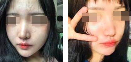 哈爾濱成美整形周小生鼻綜合案例前后對(duì)比圖 哈爾濱成美整形周小生鼻綜合案例前后對(duì)比圖