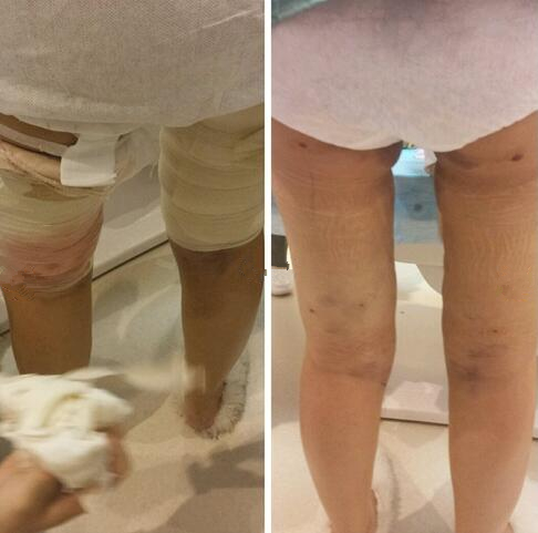 成都趙博士整形大腿吸脂案例術(shù)后即刻效果