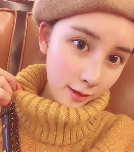 蘭州美月做膨體隆鼻術(shù)后一個(gè)月效果 蘭州美月做膨體隆鼻術(shù)后一個(gè)月效果