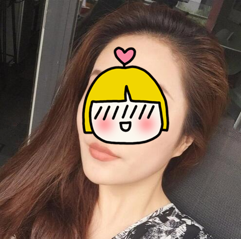 南京藝星整形趙海波面部吸脂術(shù)后一個月