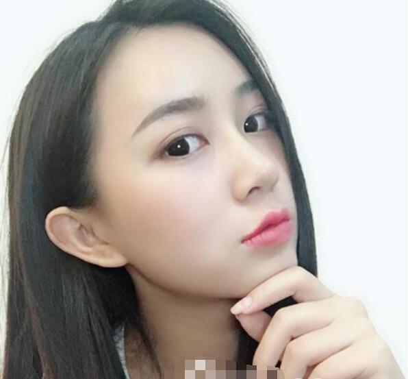 深圳鵬程整形劉冰做的鼻子術(shù)后兩個月