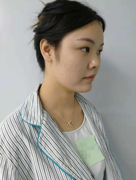 長沙雅美眼鼻整形案例分享，術(shù)后這滿滿的混血感是腫么回事