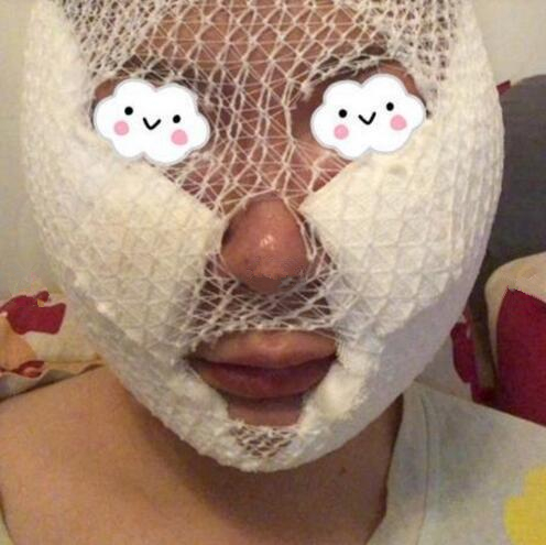 南京藝星整形趙海波面部吸脂一個(gè)月效果分享，有圖