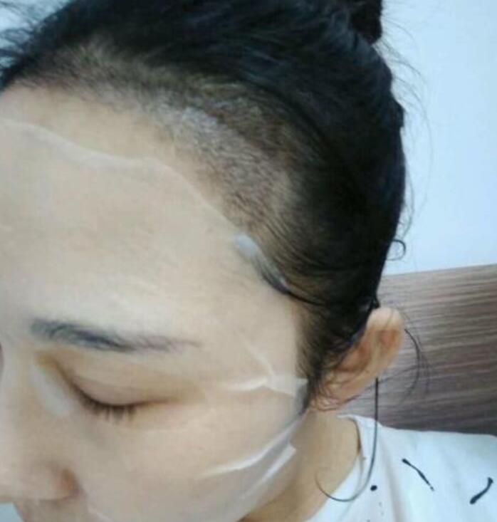 溫州新生植發(fā)種植發(fā)際線(xiàn)案例術(shù)后一個(gè)月效果