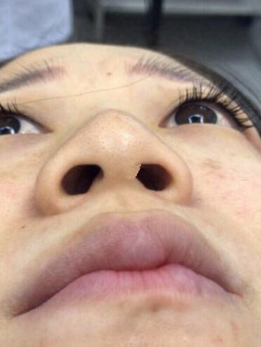 深圳福華整形陳貞宜超體隆鼻術(shù)后一個(gè)月效果反饋，有圖