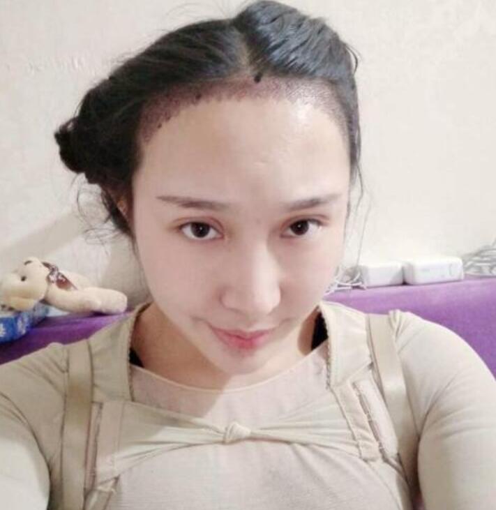 溫州新生植發(fā)種植發(fā)際線(xiàn)案例術(shù)后一周效果