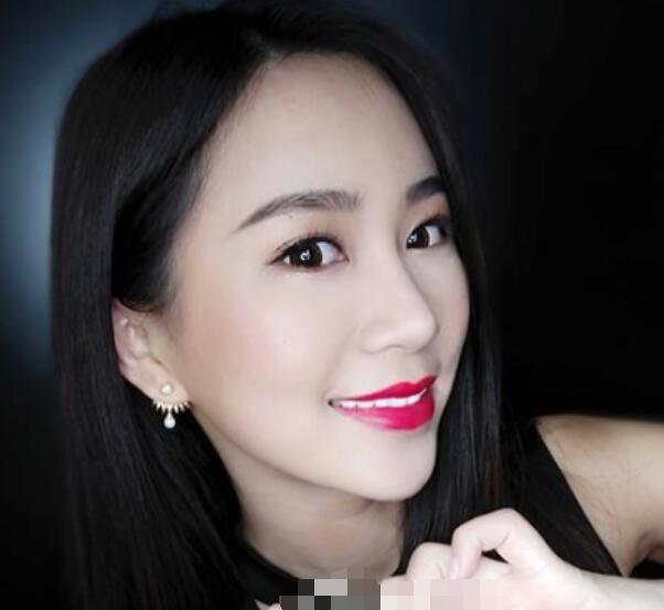 深圳鵬程整形劉冰做的鼻子術(shù)后三個月