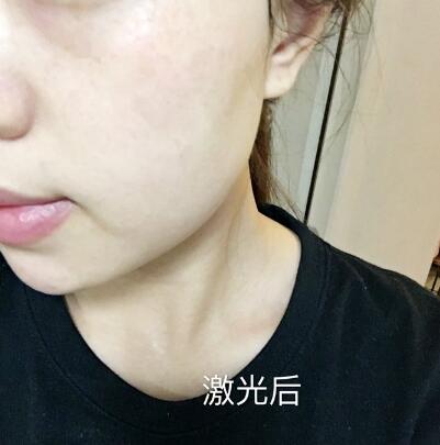 紹興維美整形激光祛斑兩個療程后 紹興維美整形激光祛斑兩個療程后