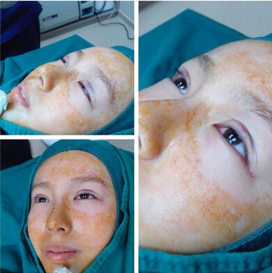 萍鄉(xiāng)麗芙整形埋線雙眼皮三個(gè)月效果分享，完全看不出來(lái)是做的