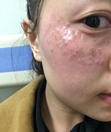 紹興維美整形激光祛斑當天 紹興維美整形激光祛斑當天