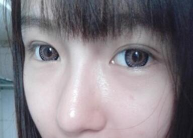 萍鄉(xiāng)麗芙整形埋線雙眼皮三個(gè)月效果分享，完全看不出來(lái)是做的