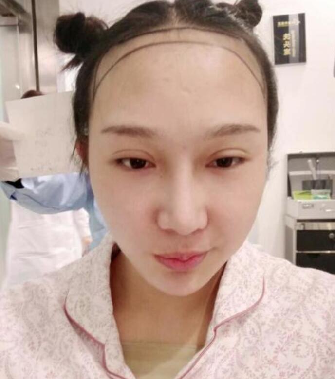 溫州新生植發(fā)種植發(fā)際線(xiàn)案例術(shù)前效果