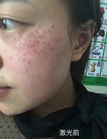 紹興維美整形激光祛斑當天 紹興維美整形激光祛斑當天