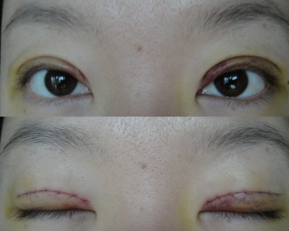 在鄭州望京做全切雙眼皮+開外眼角，術(shù)后效果確實(shí)沒讓我失望