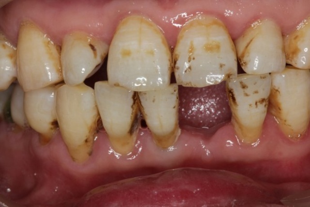 深圳正夫口腔種植牙案例分享，這下可以好好吃飯了