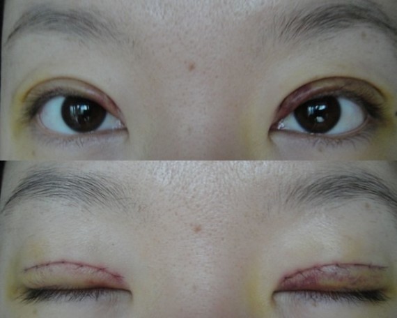 鄭州望京做全切雙眼皮+開外眼角術(shù)后一周