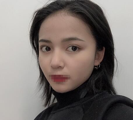 長(zhǎng)沙愛思特整形定點(diǎn)雙眼皮半年 長(zhǎng)沙愛思特整形定點(diǎn)雙眼皮半年