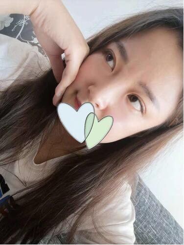 濟南韓式整形雙眼皮術(shù)后一個月 濟南韓式整形雙眼皮術(shù)后一個月