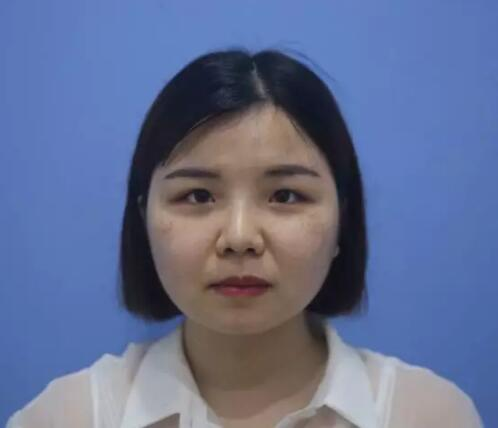 長沙星雅整形激光祛斑三個月效果分享，白白凈凈誰看了不愛