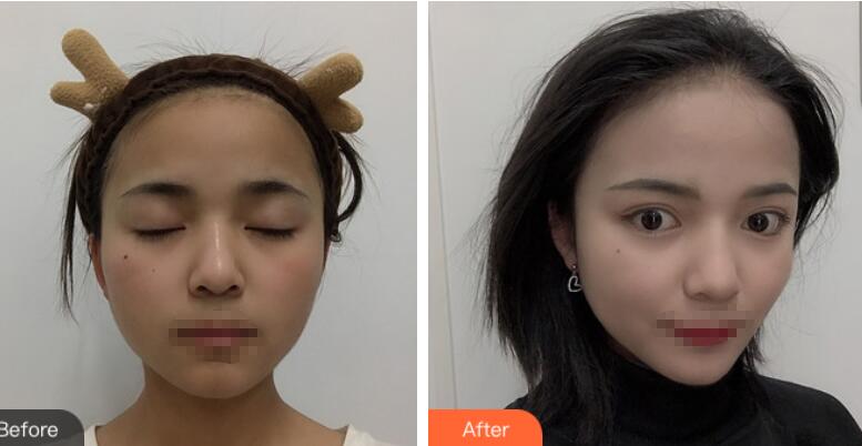 長(zhǎng)沙愛思特整形定點(diǎn)雙眼皮前后對(duì)比圖 長(zhǎng)沙愛思特整形定點(diǎn)雙眼皮前后對(duì)比圖