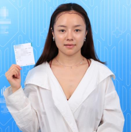 廈門新生植發(fā)種植發(fā)際線半年效果分享，一鍵get高顱頂