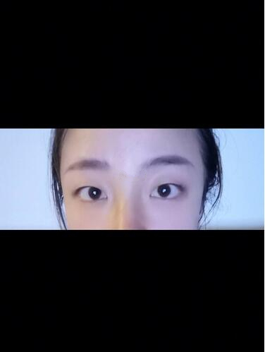 西安時光整形郭淑華雙眼皮案例分享，一個月就這么自然
