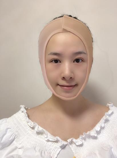 南方醫(yī)院整形美容科顴骨內(nèi)推術(shù)后一周