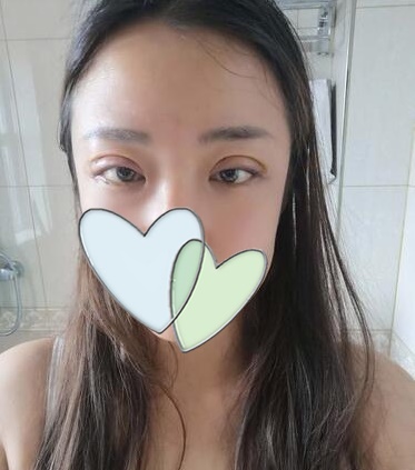 西安時(shí)光整形郭淑華雙眼皮案例術(shù)后一周 西安時(shí)光整形郭淑華雙眼皮案例術(shù)后一周