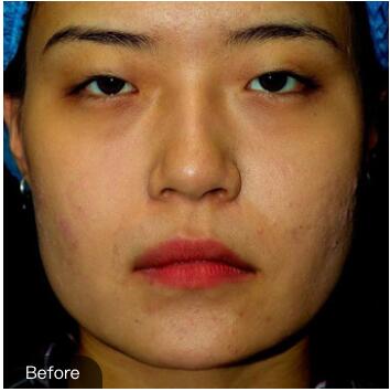 重慶華美下頜角整形術(shù)前 重慶華美下頜角整形術(shù)前