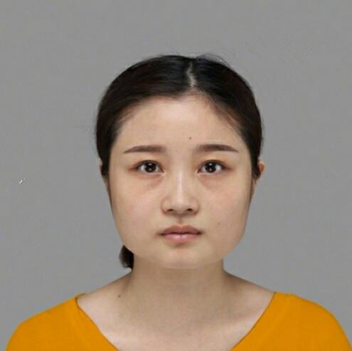 重慶美聯(lián)臣下頜角整形前 重慶美聯(lián)臣下頜角整形前