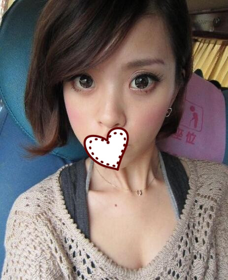 鄭州蘊(yùn)美整形玻尿酸隆鼻案例分享，效果即刻看得見(jiàn)