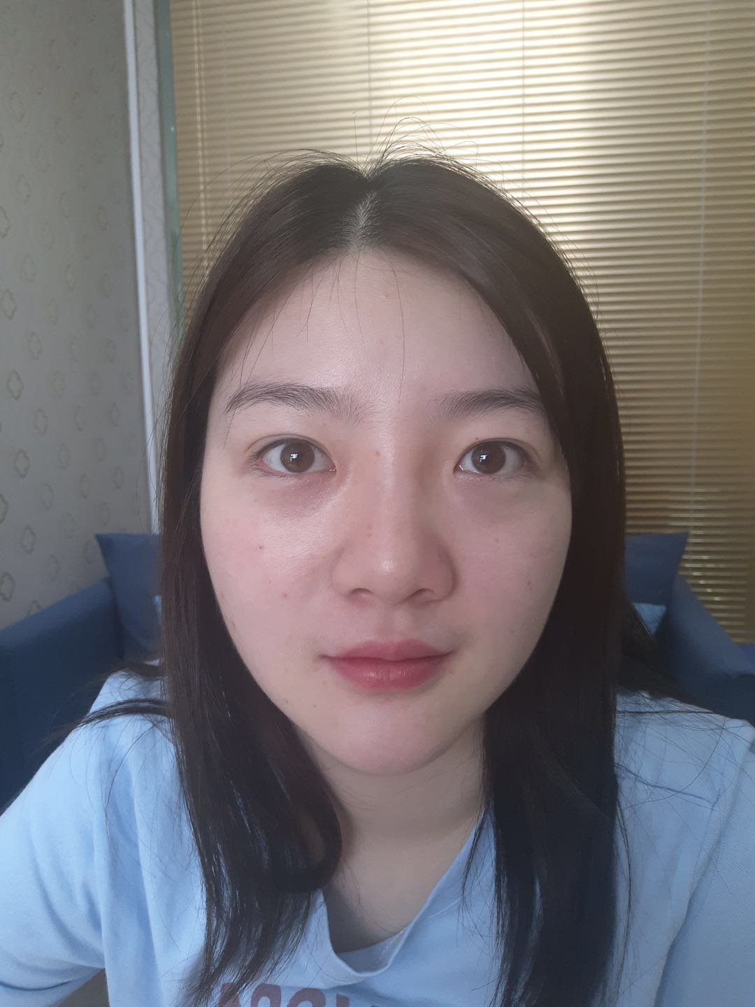 北京圣嘉榮二次鼻修復前