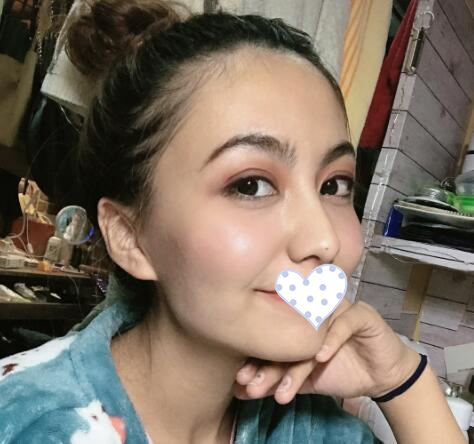 徐州時(shí)光洪揚(yáng)整形雙眼皮術(shù)后一個(gè)月效果 徐州時(shí)光洪揚(yáng)整形雙眼皮術(shù)后一個(gè)月效果