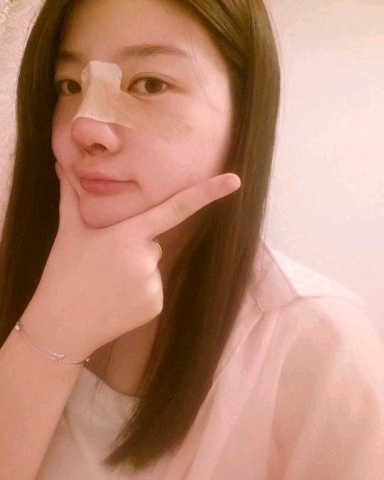 北京圣嘉榮二次鼻修復術后三天