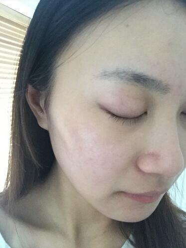 合肥艾雅整形紅藍(lán)光祛痘兩個療程效果，痘痘都消失了