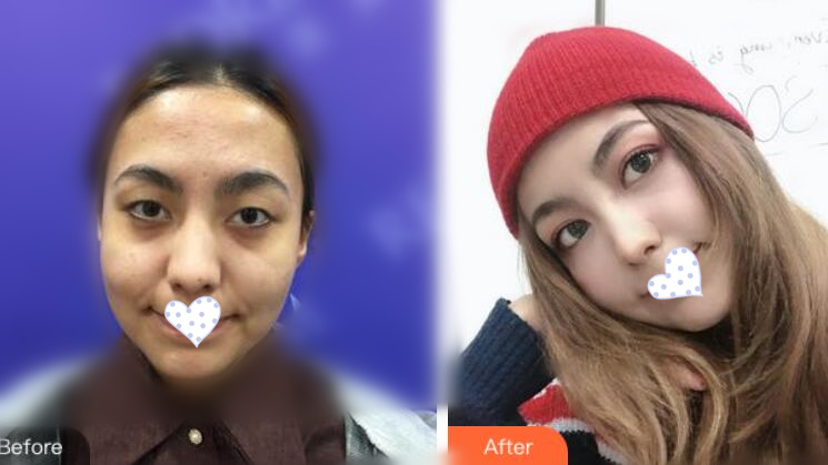 徐州時(shí)光洪揚(yáng)整形雙眼皮案例前后對(duì)比圖