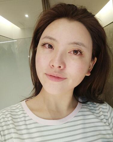 上海首爾麗格樸興植下頜角整形一個月